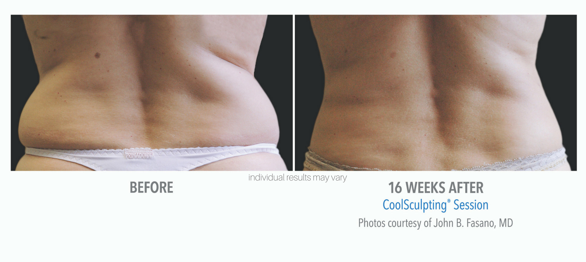 coolsculpting-before-and-after-photos-3