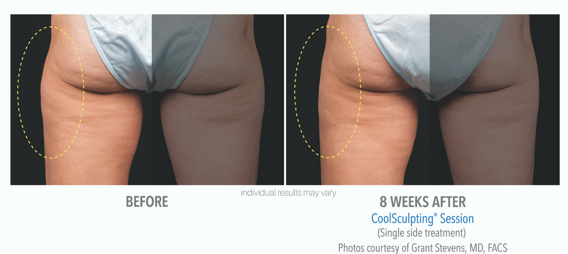 coolsculpting-before-and-after-photos-5