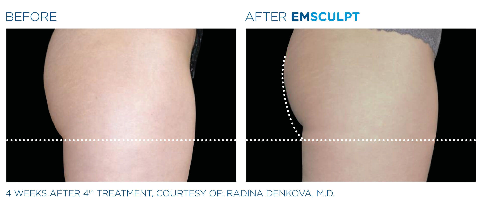 emsculpt-before-and-after-1
