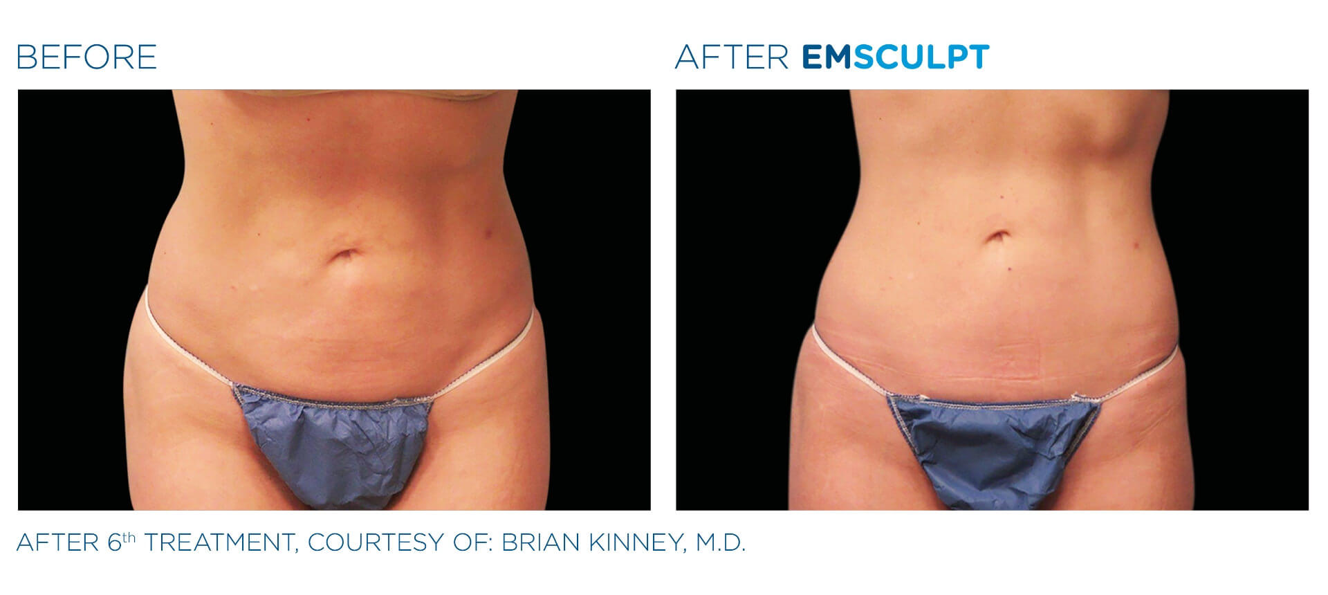 emsculpt-before-and-after-4