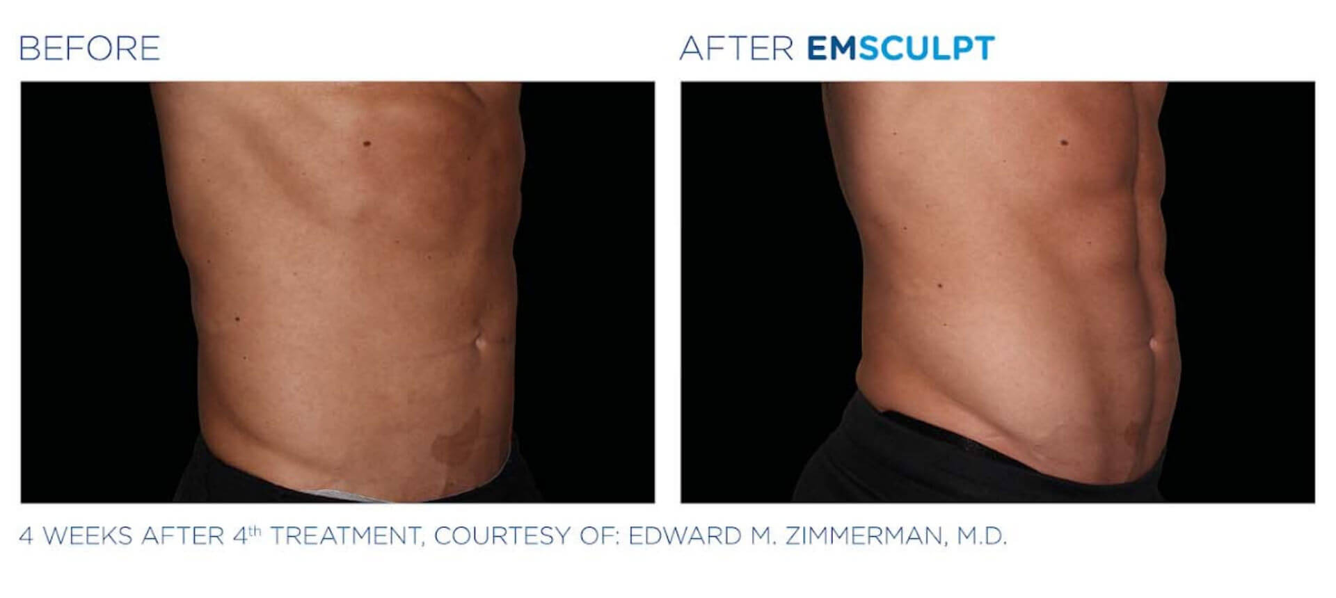 emsculpt-before-and-after-5