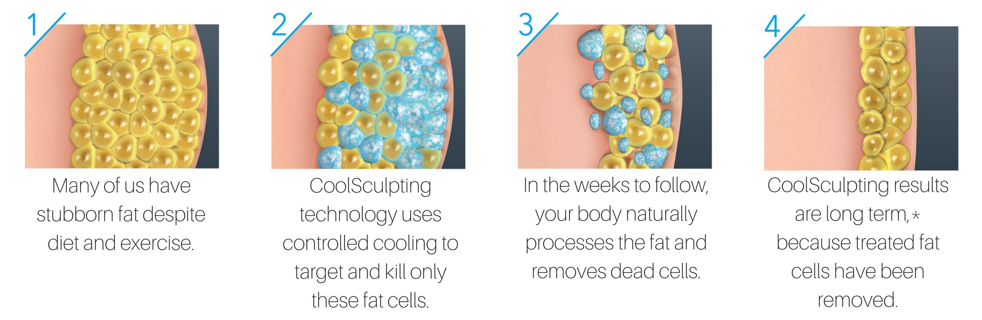 how coolsculpting works on our body fat