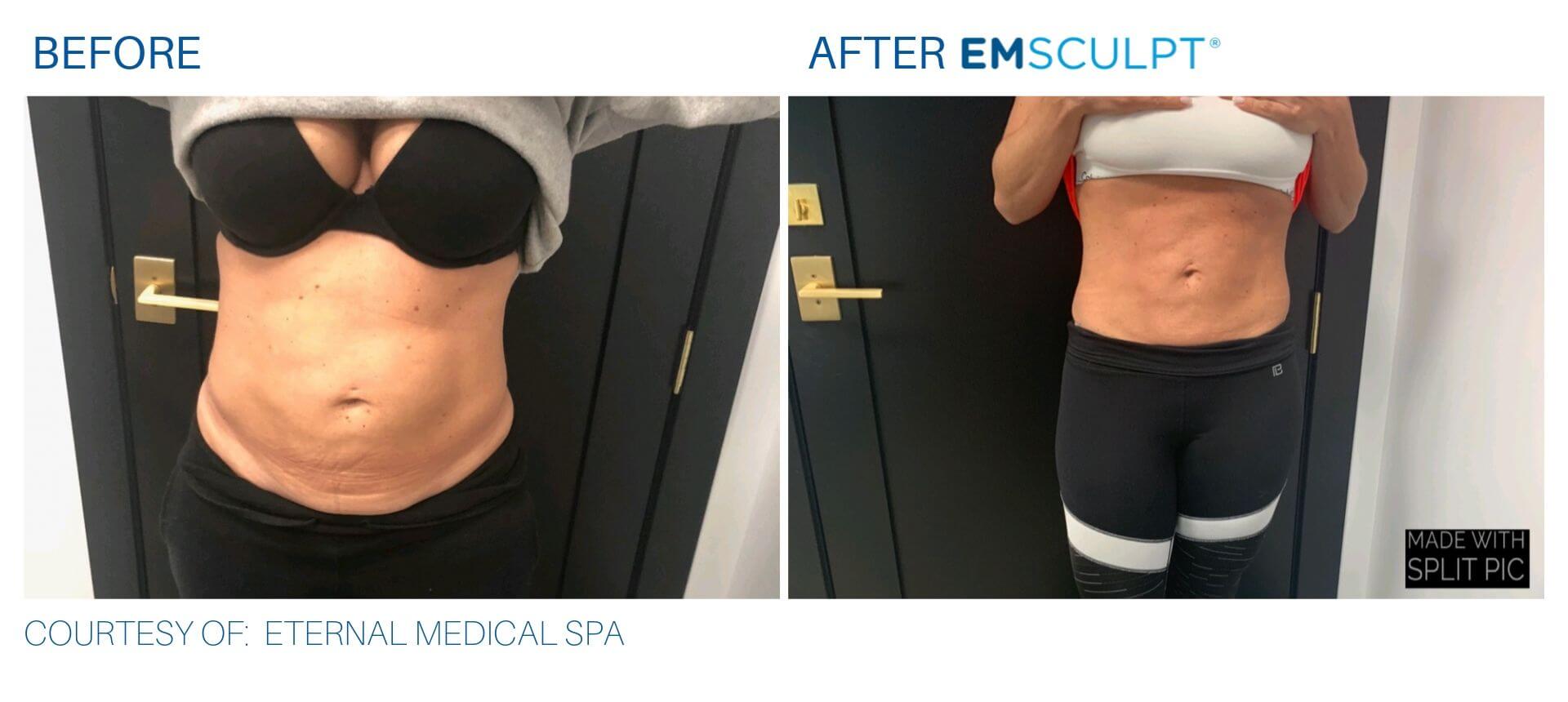 EmSculpt before and after Eternal Medical Spa