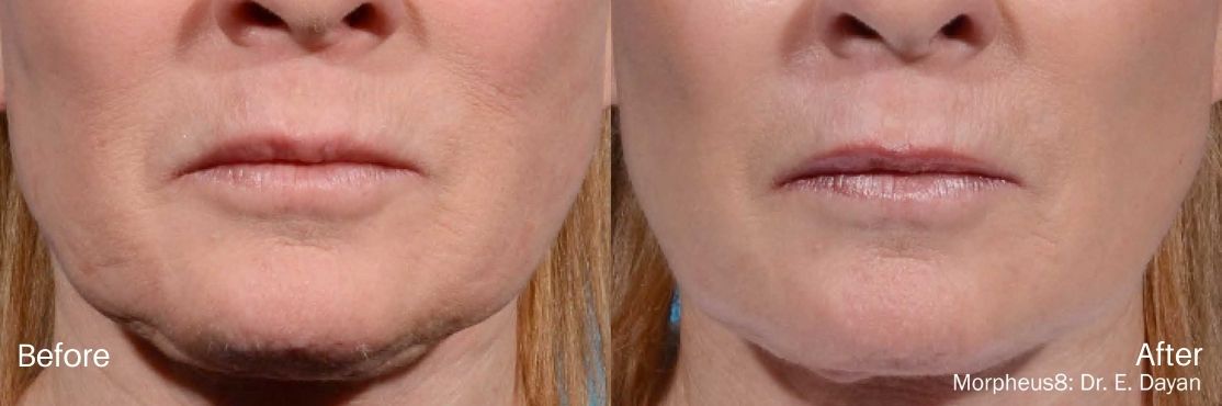rf-microneedling-morpheus8-before-abd-after-3