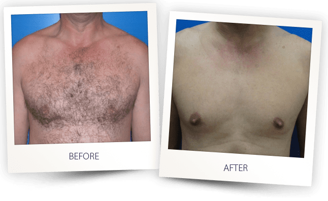 saprano-titanium-laser-hair-removal-before-and-after-eternal-medspa-1