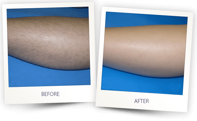 saprano-titanium-laser-hair-removal-before-and-after-eternal-medspa-2