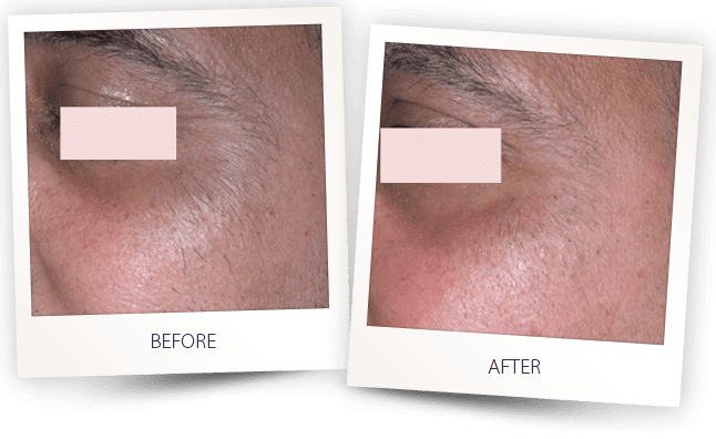 saprano-titanium-laser-hair-removal-before-and-after-eternal-medspa-5