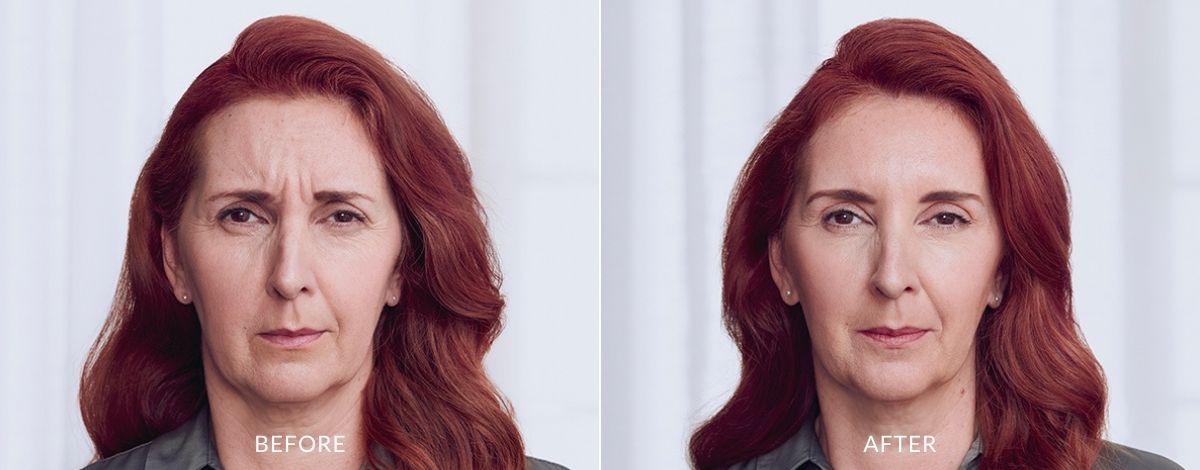 botox-before-and-after-image-4