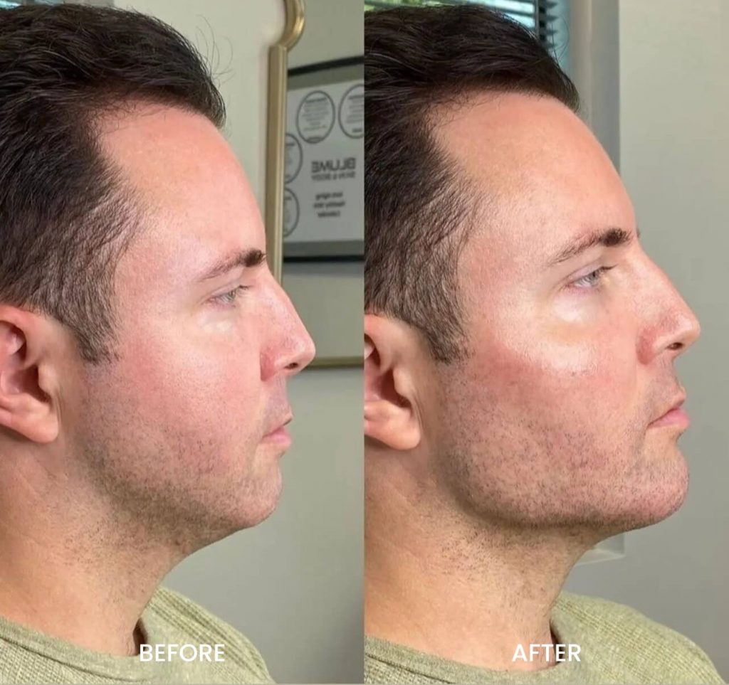 Dermal Fillers in Little Falls Juvéderm Restylane