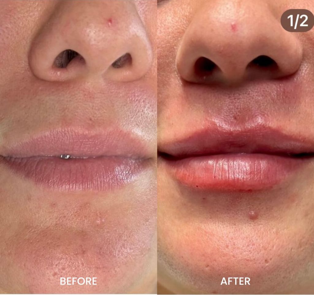 Dermal Fillers in Little Falls Juvéderm Restylane