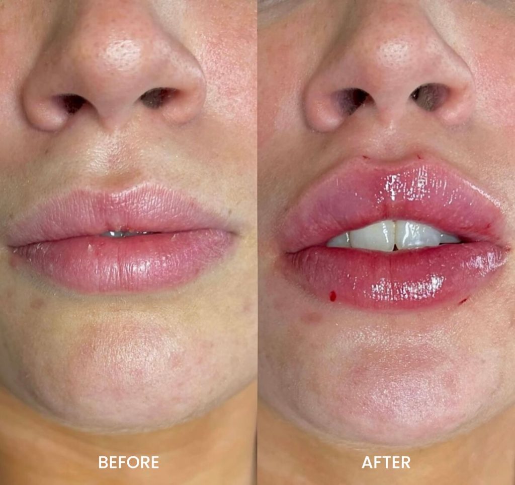 Dermal Fillers in Little Falls Juvéderm Restylane